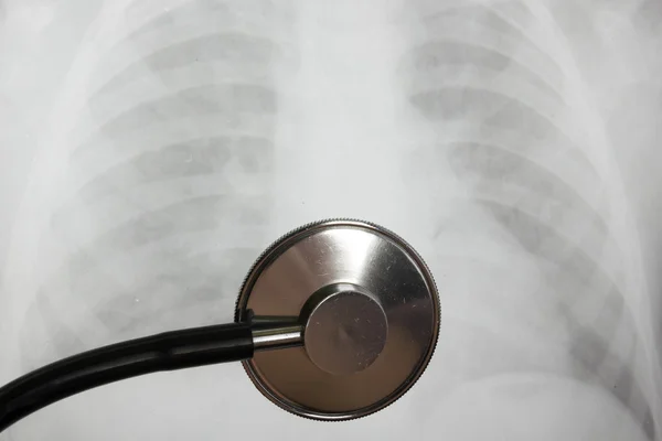 Medical stethoscope and x-ray or roentgen image. Close-up shot of lung radiography