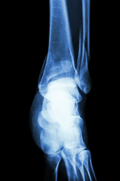 Film x-ray ankle show fracture distal tibia and fibula (leg's bone)