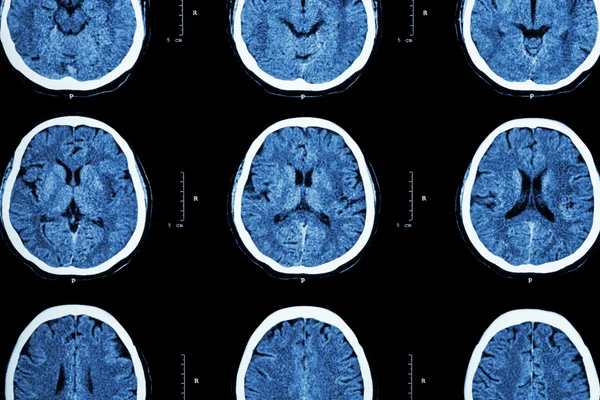 CT scan of brain show normal brain ( Neurological background )