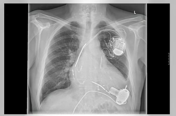 X-ray image, links, artificial heart pacemaker